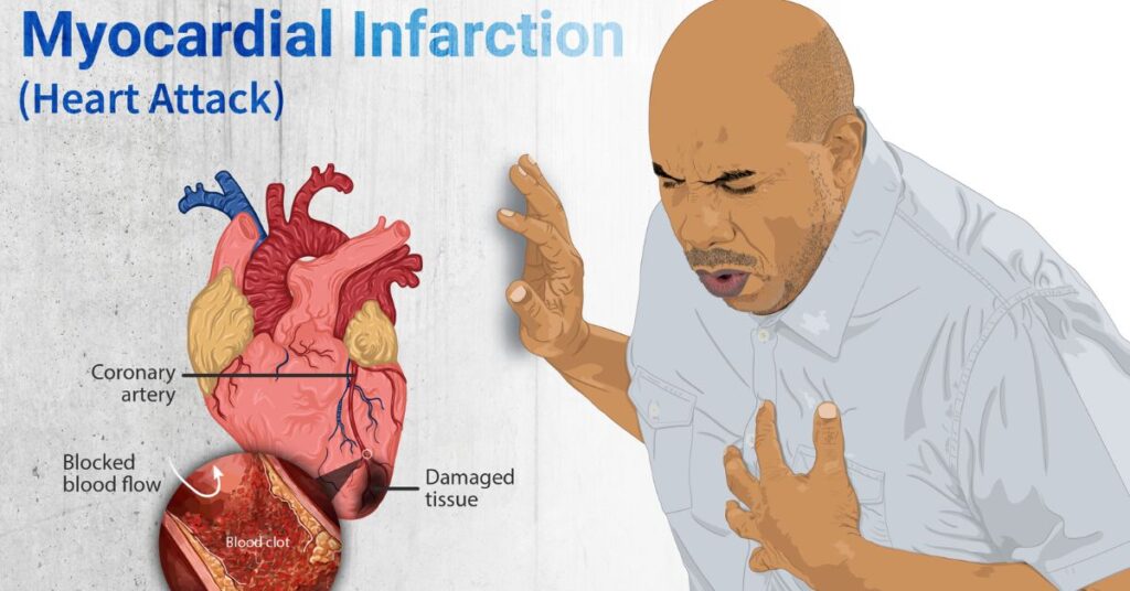 MYOCARDIAL INFARCTION – Medical Centric