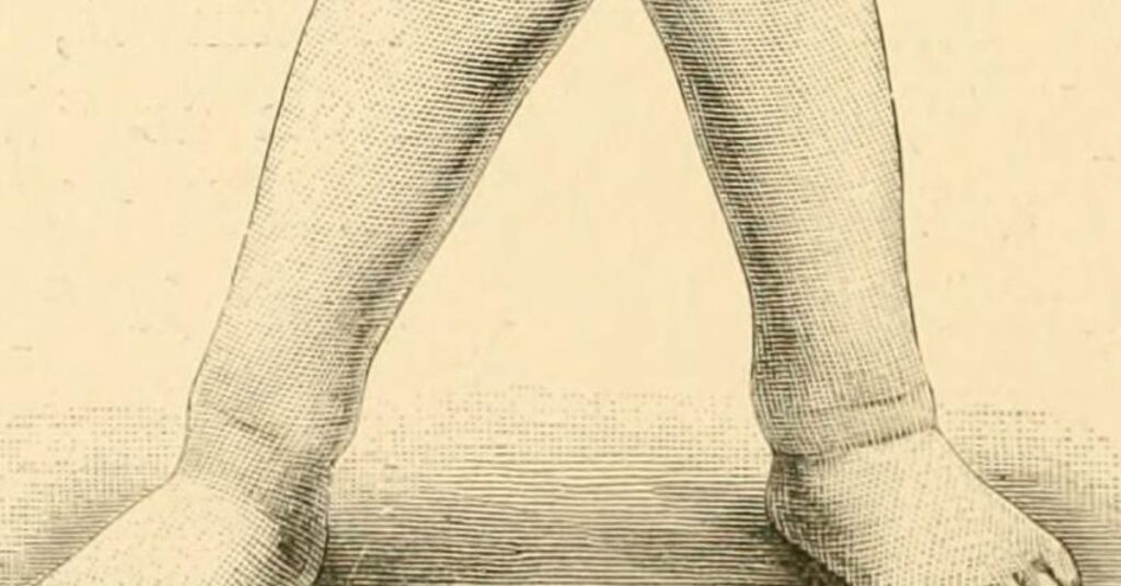 RICKETS – Medical Centric