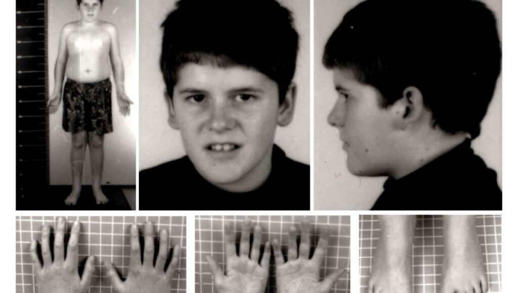 These Prader Willi Syndrome Pictures Are Going Viral See Why - qd3wafq